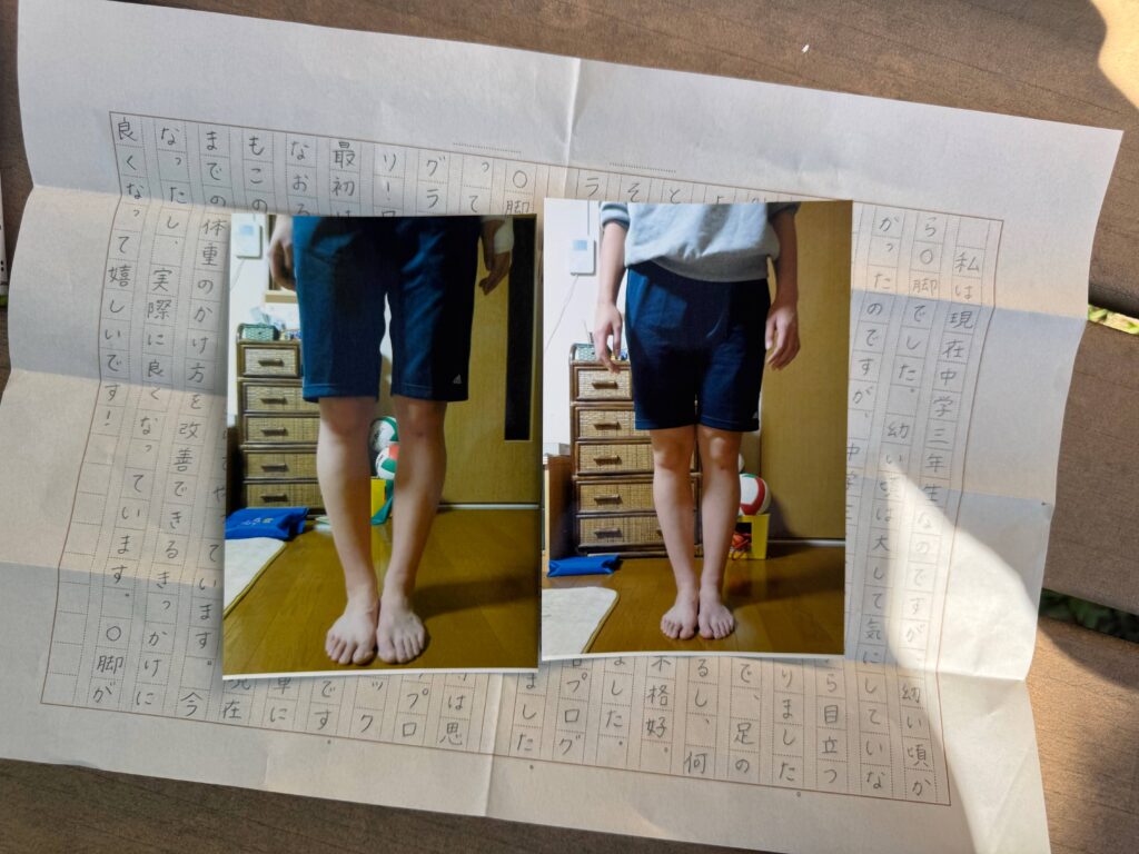 O脚ストレッチの体験談(※個人の感想)ビフォーアフター写真