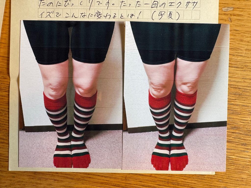 O脚ストレッチの体験談(※個人の感想)ビフォーアフター写真