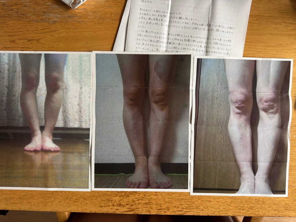 O脚ストレッチの体験談(※個人の感想)ビフォーアフター写真