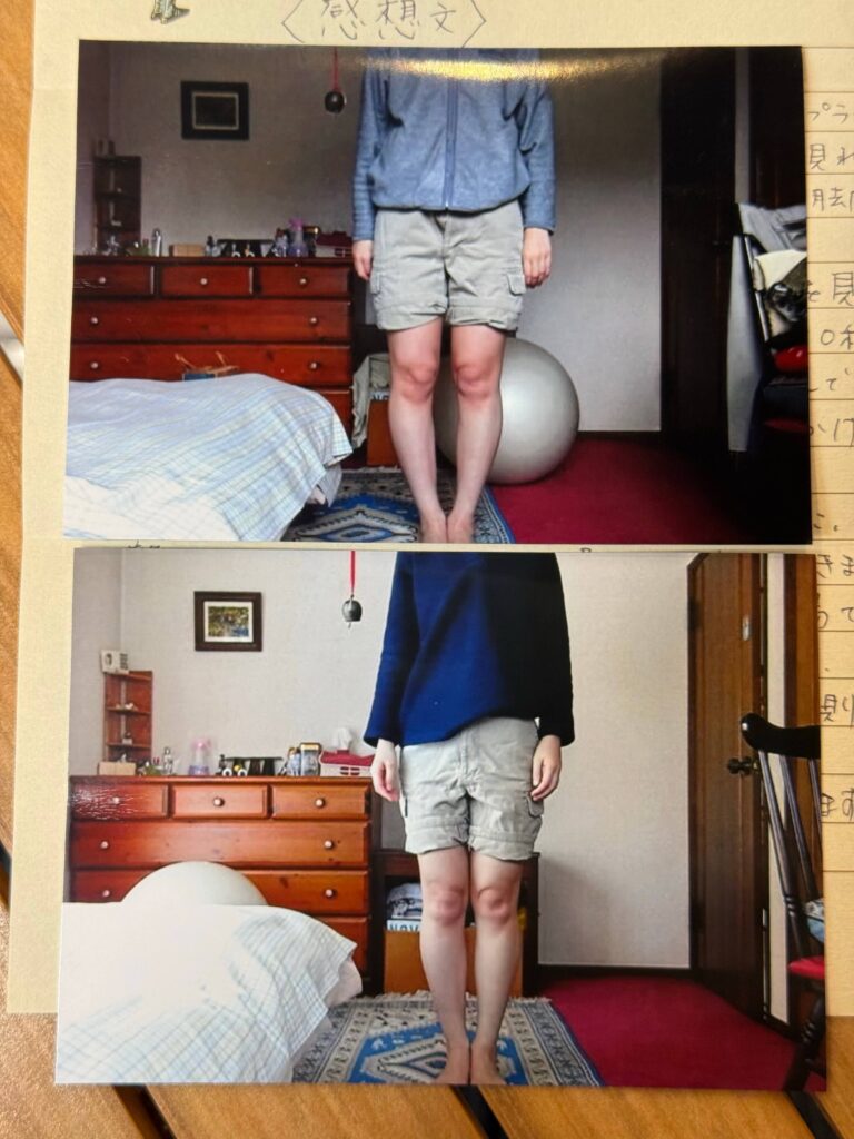 O脚ストレッチの体験談(※個人の感想)ビフォーアフター写真