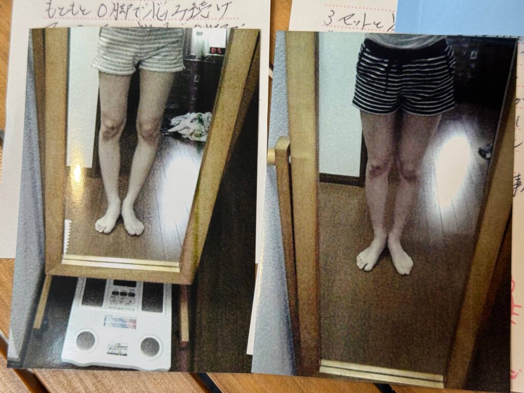 O脚ストレッチの体験談(※個人の感想)ビフォーアフター写真