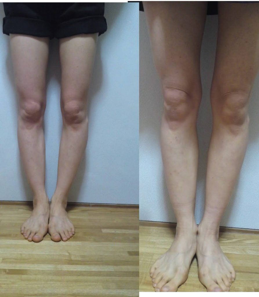 O脚ストレッチの体験談(※個人の感想)ビフォーアフター写真