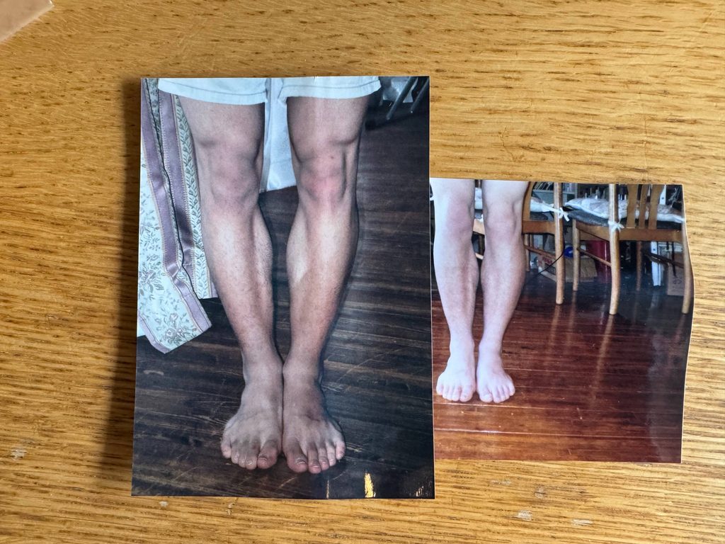 O脚ストレッチの体験談(※個人の感想)ビフォーアフター写真