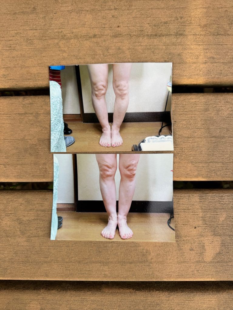O脚ストレッチの体験談(※個人の感想)ビフォーアフター写真