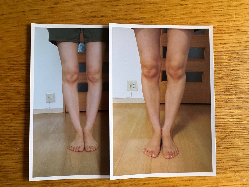 O脚ストレッチの体験談(※個人の感想)ビフォーアフター写真