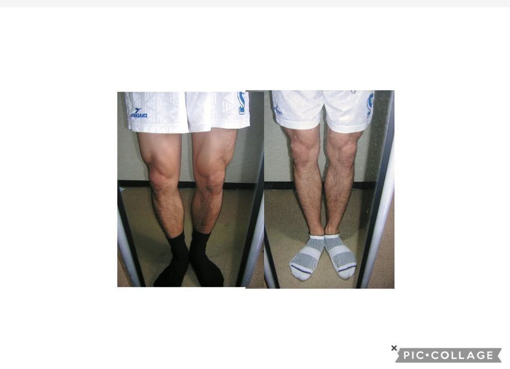 O脚ストレッチの体験談(※個人の感想)ビフォーアフター写真