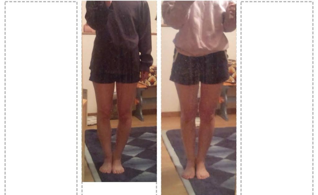 O脚ストレッチの体験談(※個人の感想)ビフォーアフター写真