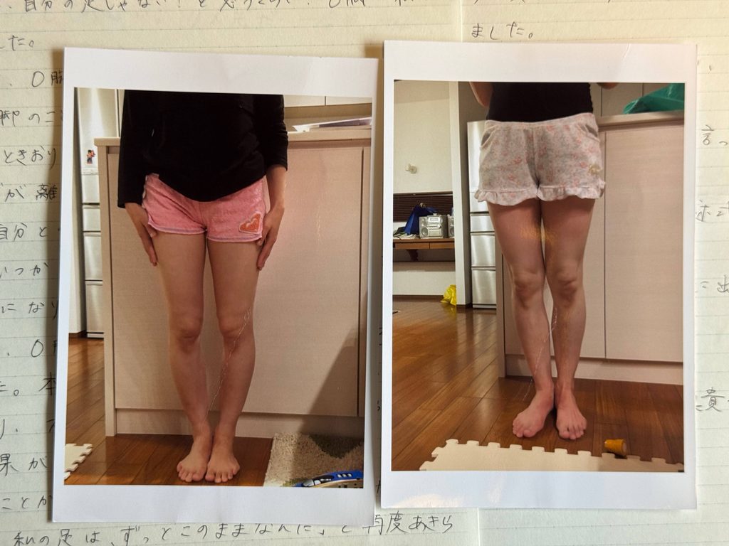 O脚ストレッチの体験談(※個人の感想)ビフォーアフター写真