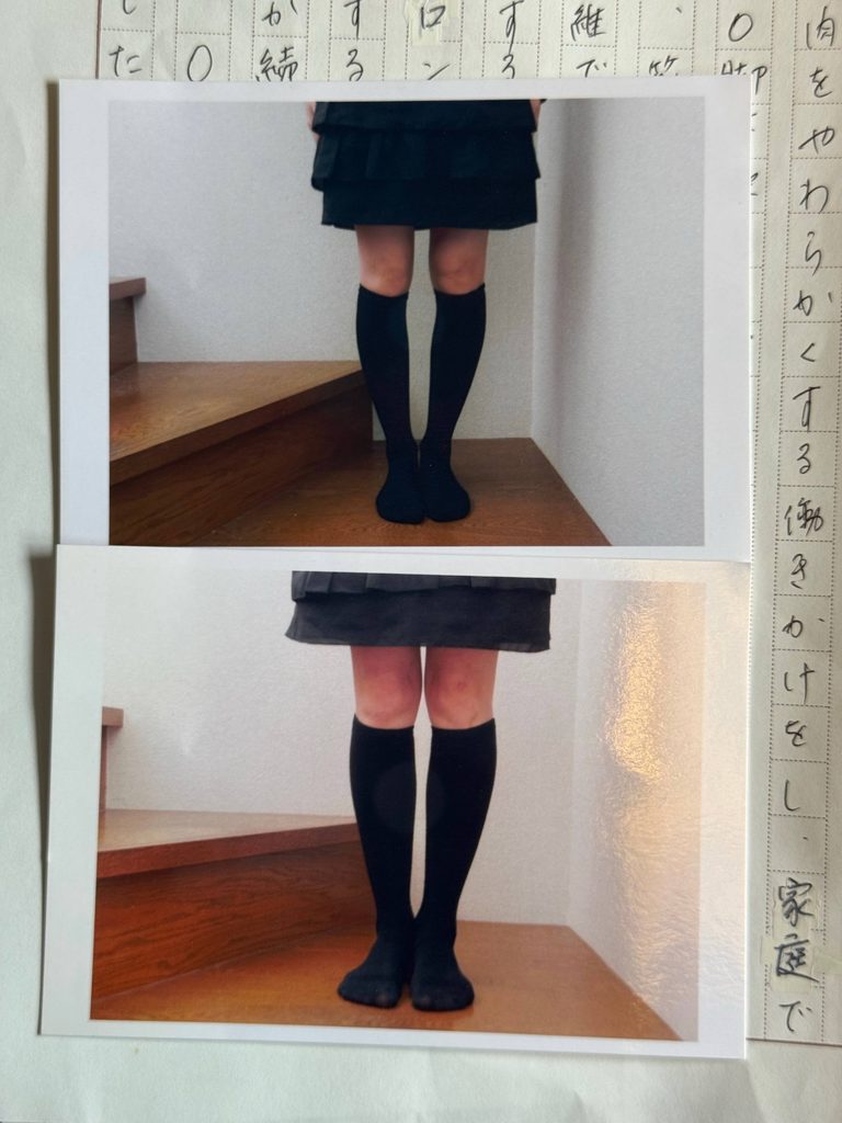 O脚ストレッチの体験談(※個人の感想)ビフォーアフター写真
