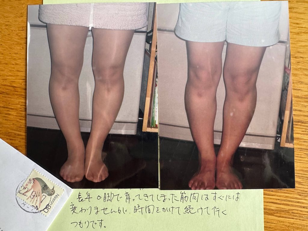 O脚ストレッチの体験談(※個人の感想)ビフォーアフター写真