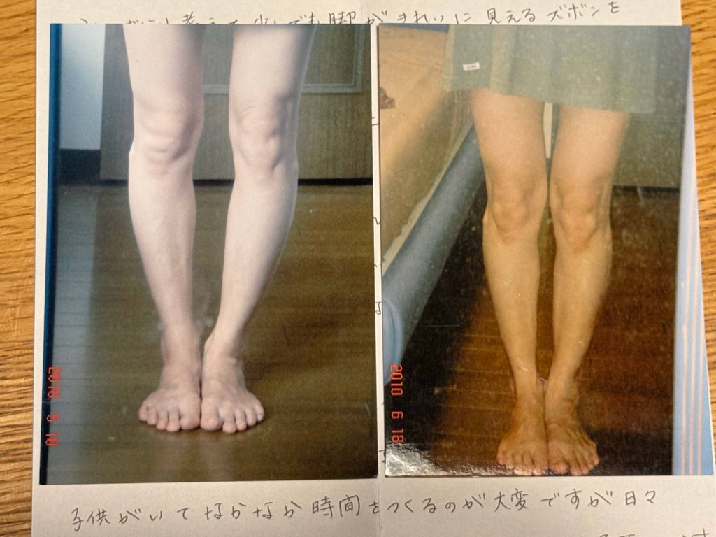 O脚ストレッチの体験談(※個人の感想)ビフォーアフター写真