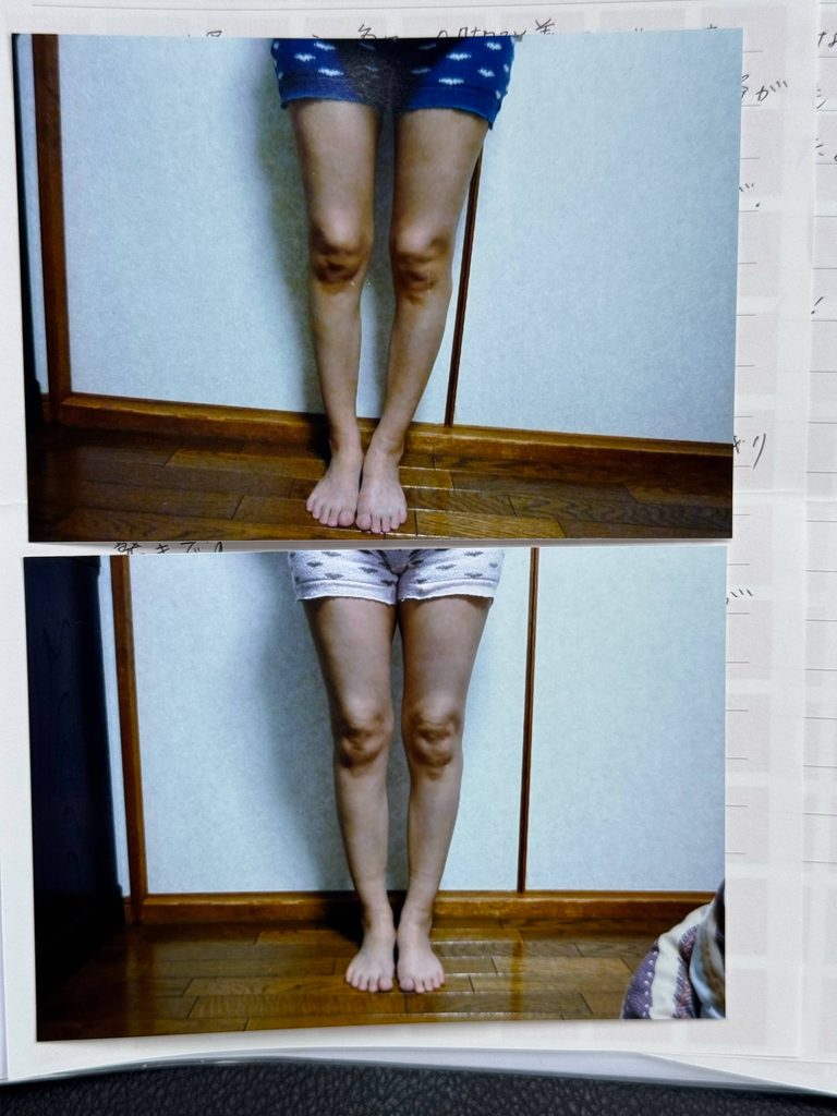 O脚ストレッチの体験談(※個人の感想)ビフォーアフター写真