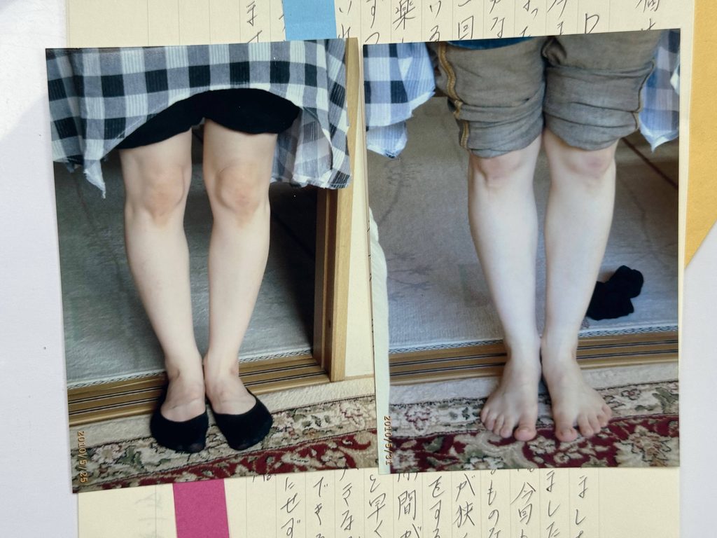 O脚ストレッチの体験談(※個人の感想)ビフォーアフター写真