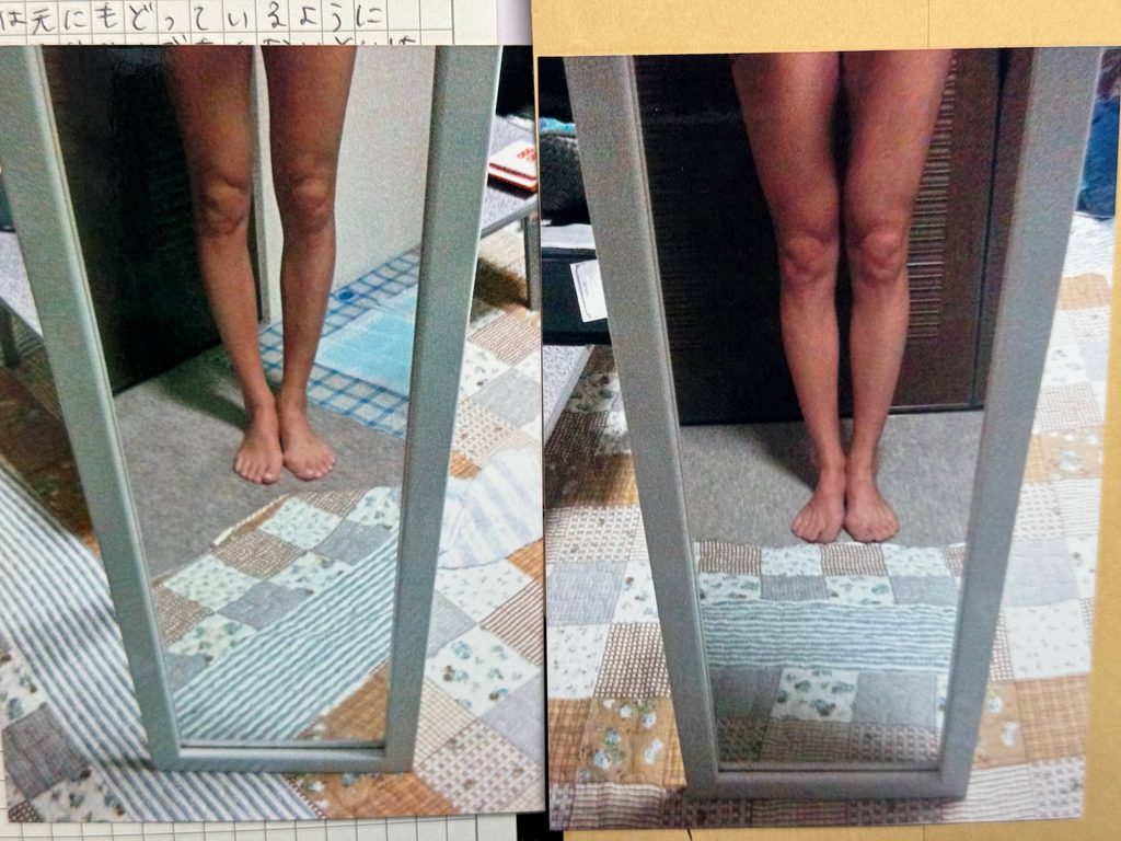 O脚ストレッチの体験談(※個人の感想)ビフォーアフター写真