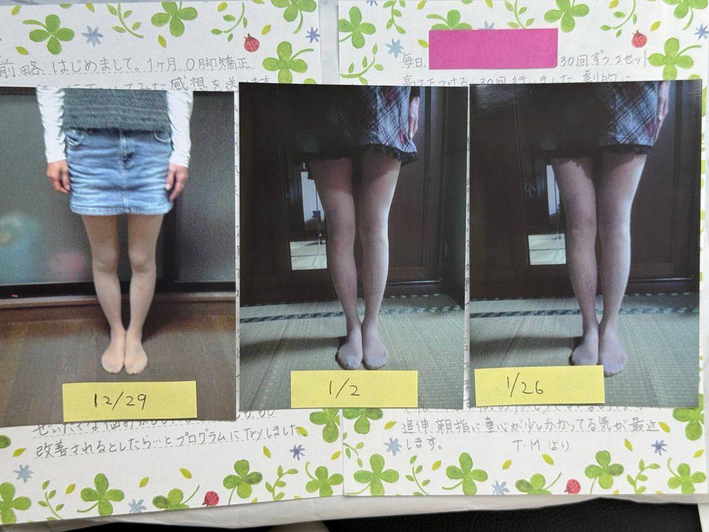 O脚ストレッチの体験談(※個人の感想)ビフォーアフター写真