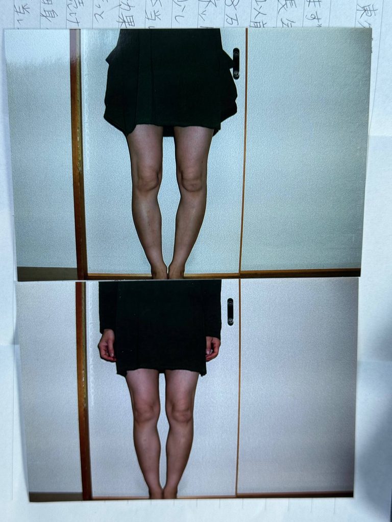 O脚ストレッチの体験談(※個人の感想)ビフォーアフター写真