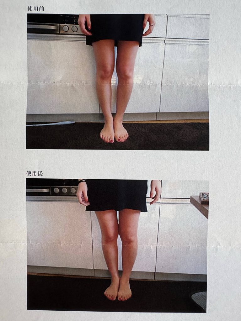 O脚ストレッチの体験談(※個人の感想)ビフォーアフター写真