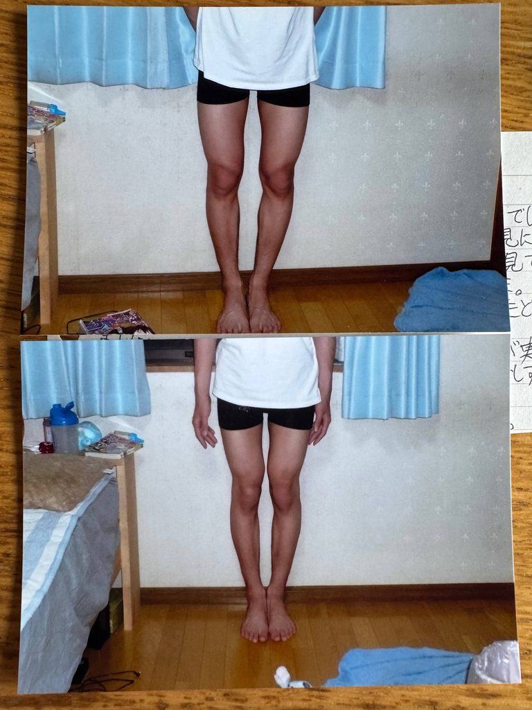 O脚ストレッチの体験談(※個人の感想)ビフォーアフター写真