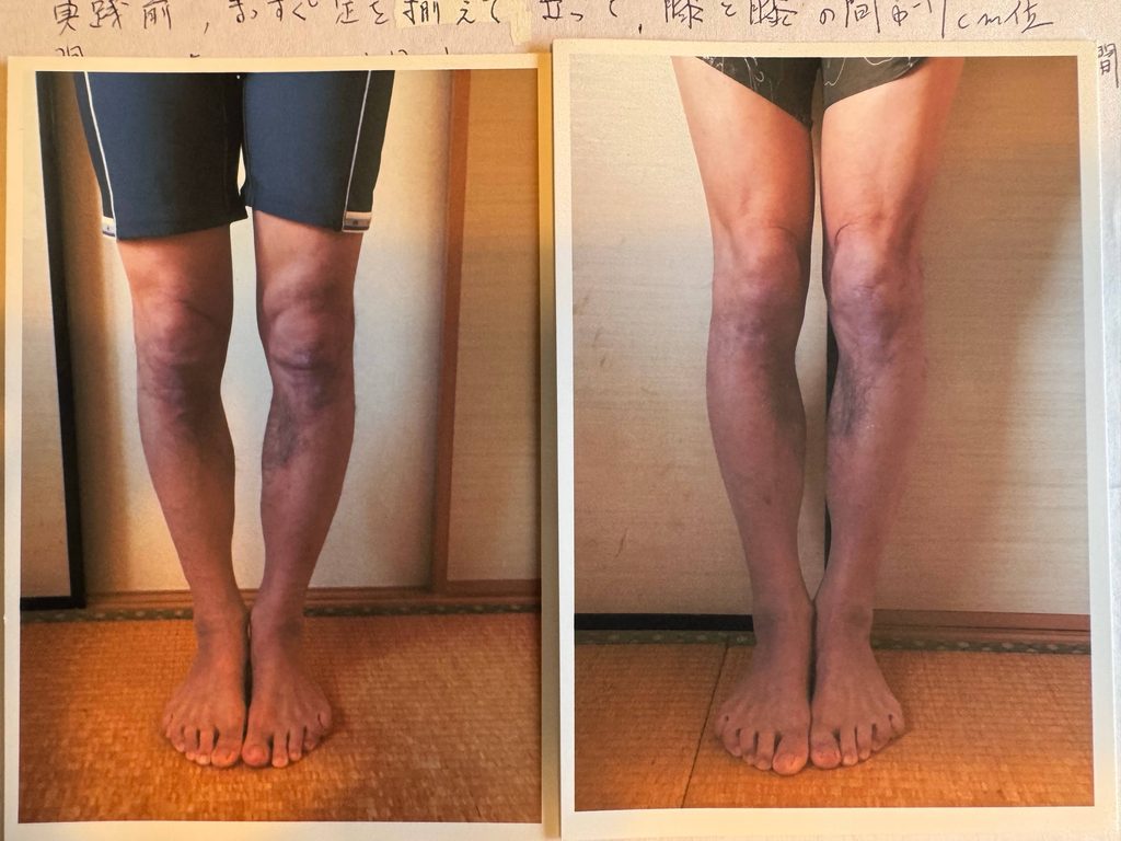 O脚ストレッチの体験談(※個人の感想)ビフォーアフター写真
