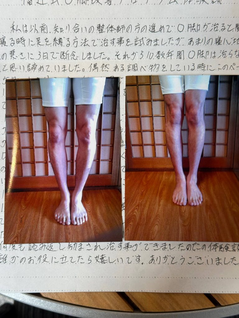 O脚ストレッチの体験談(※個人の感想)ビフォーアフター写真