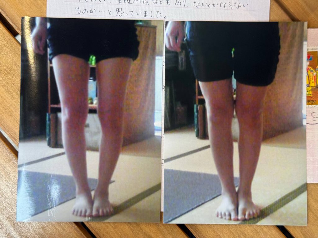 O脚ストレッチの体験談(※個人の感想)ビフォーアフター写真