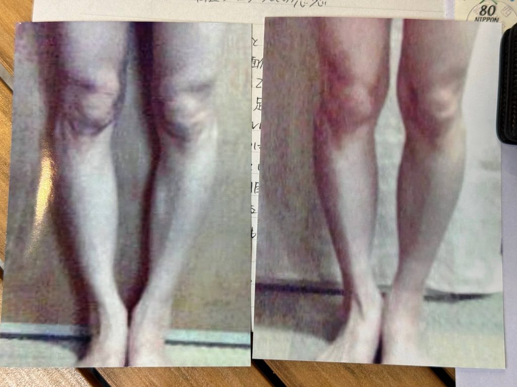 O脚ストレッチの体験談(※個人の感想)ビフォーアフター写真