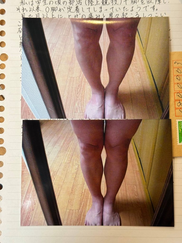 O脚ストレッチの体験談(※個人の感想)ビフォーアフター写真