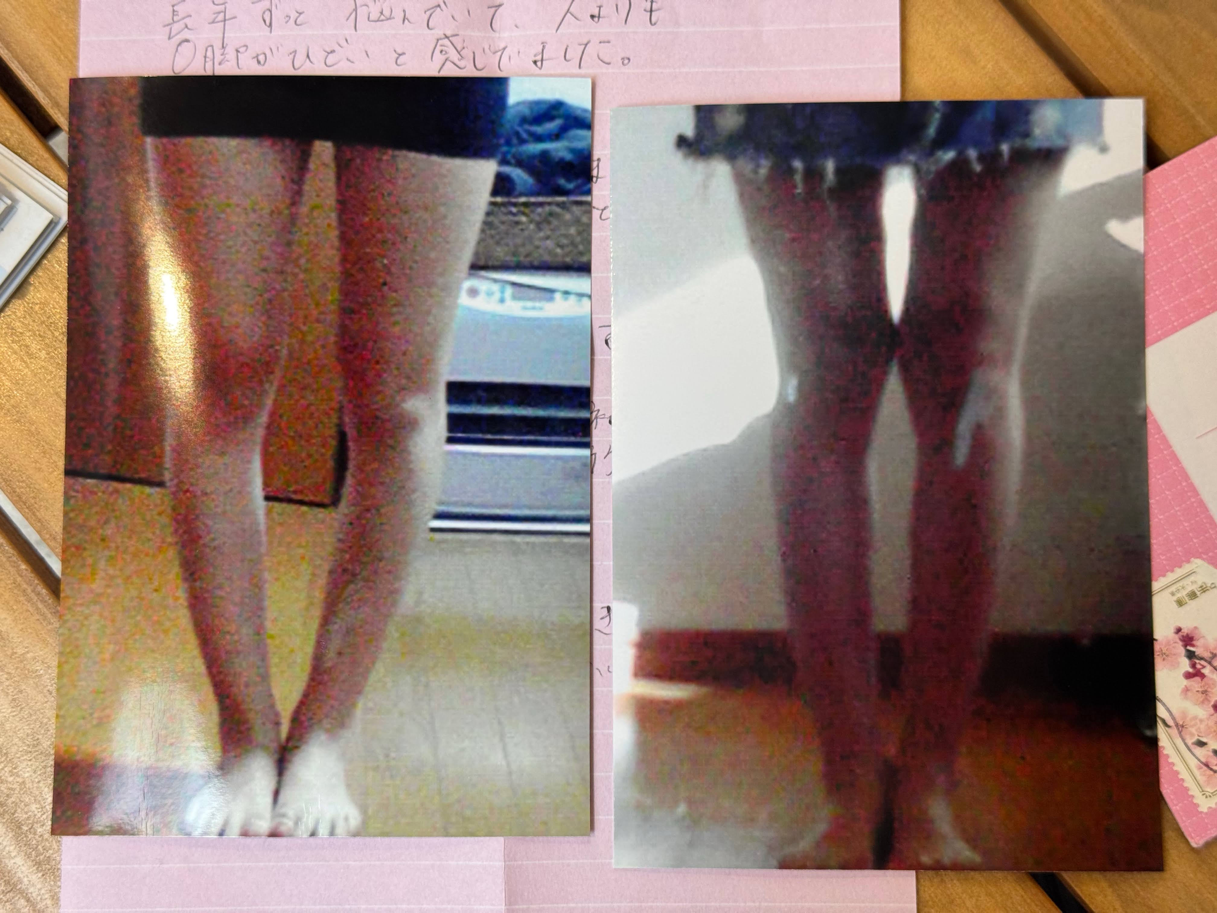 O脚ストレッチの体験談(※個人の感想)ビフォーアフター写真