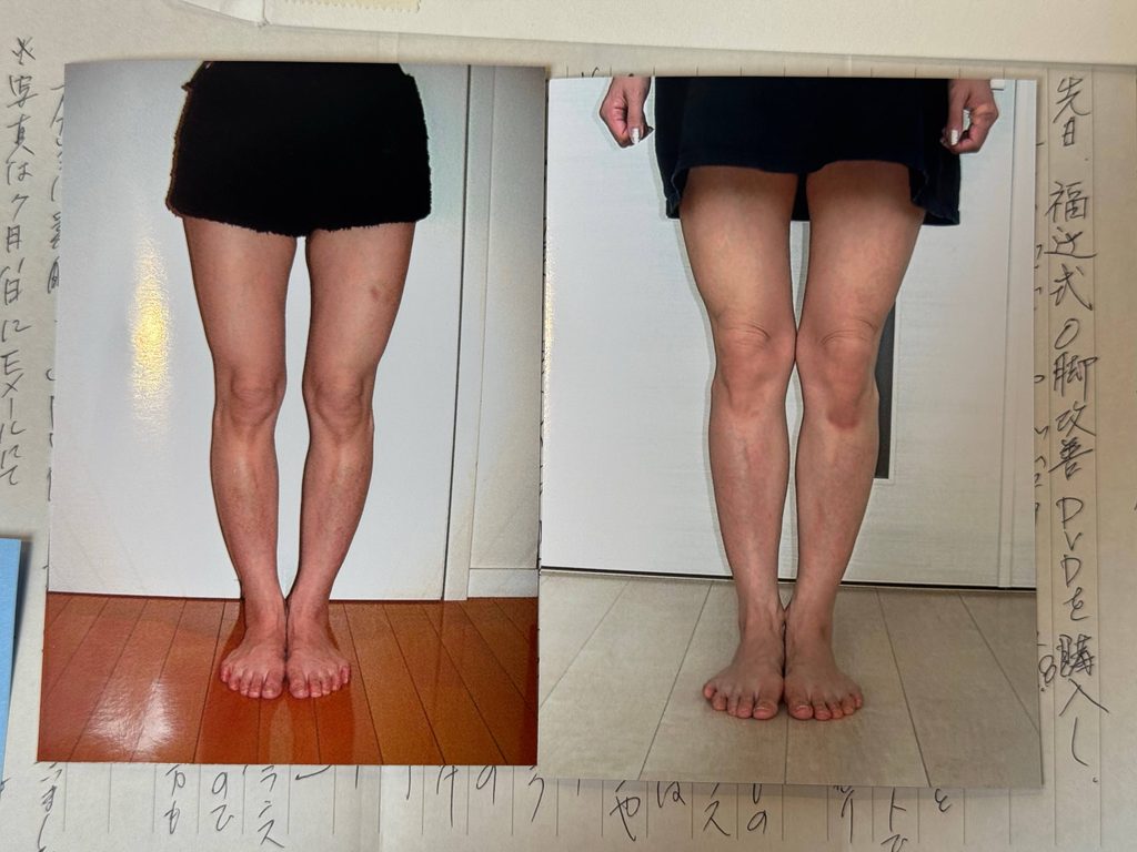 O脚ストレッチの体験談(※個人の感想)ビフォーアフター写真