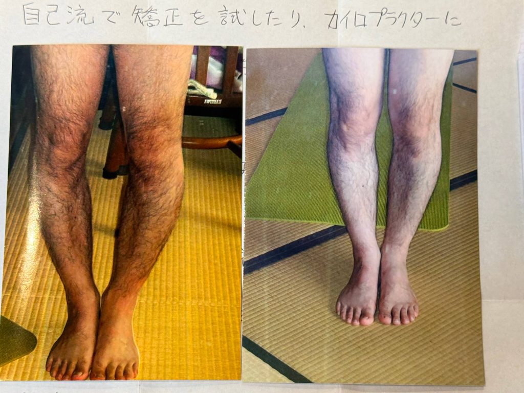 O脚ストレッチの体験談(※個人の感想)ビフォーアフター写真
