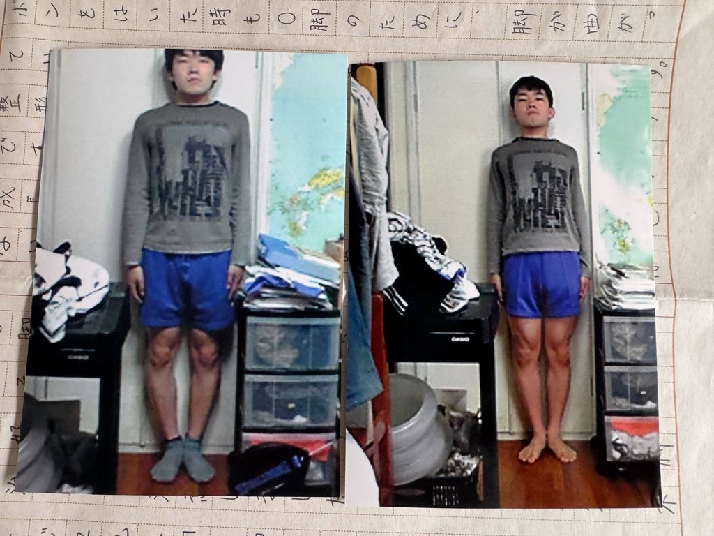 O脚ストレッチの体験談(※個人の感想)ビフォーアフター写真