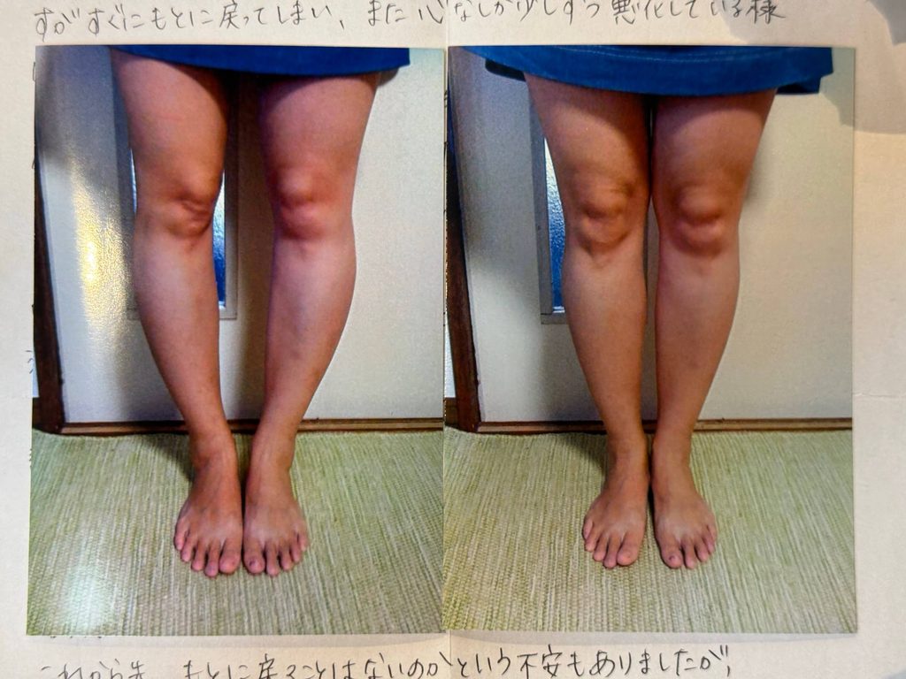 O脚ストレッチの体験談(※個人の感想)ビフォーアフター写真