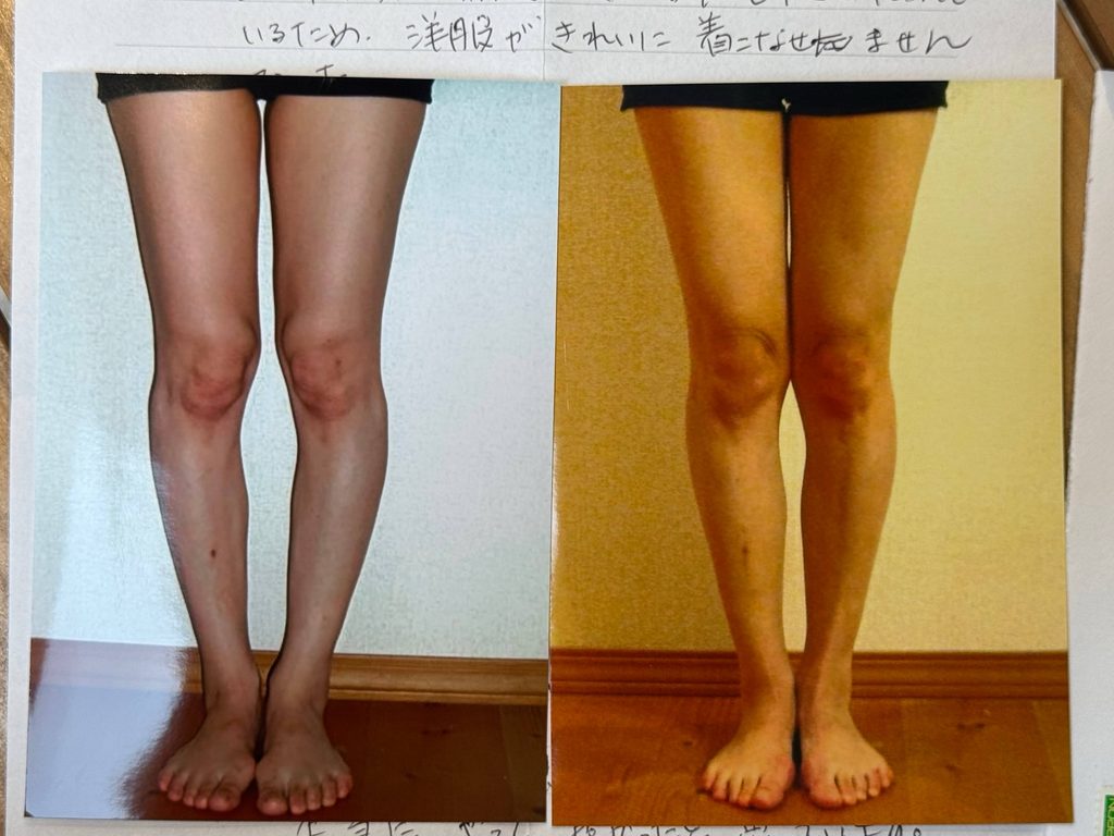 O脚ストレッチの体験談(※個人の感想)ビフォーアフター写真