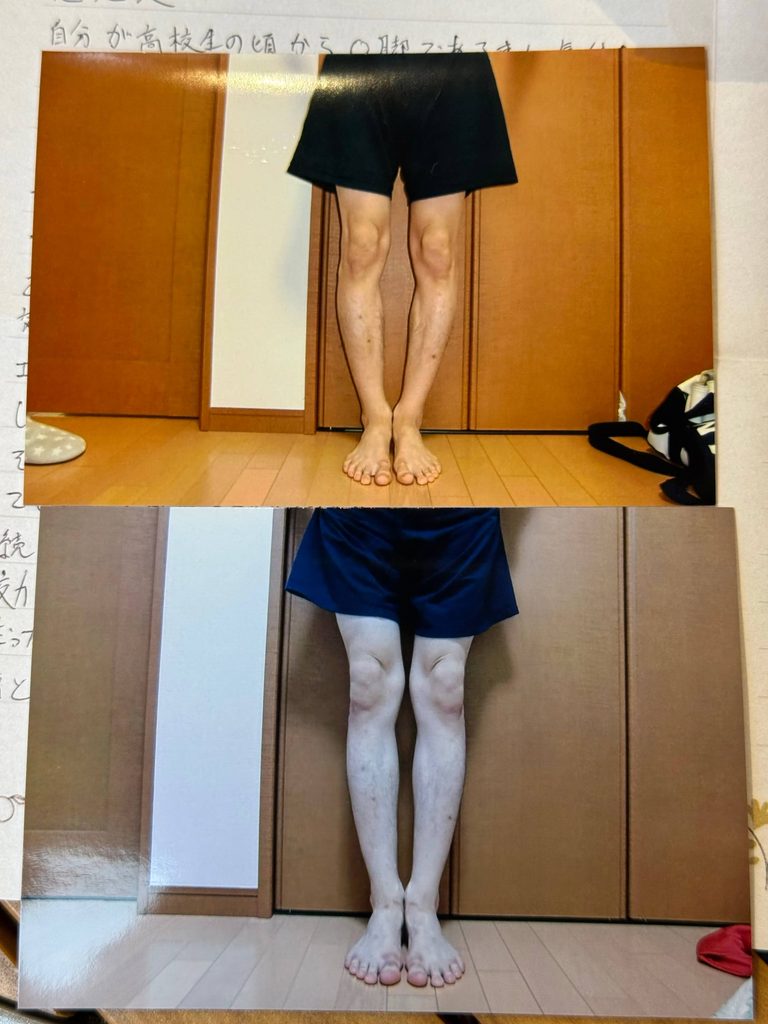 O脚ストレッチの体験談(※個人の感想)ビフォーアフター写真