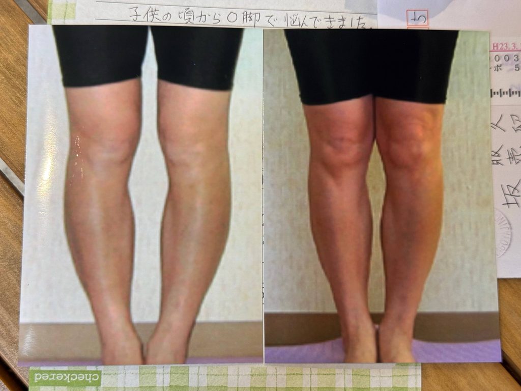 O脚ストレッチの体験談(※個人の感想)ビフォーアフター写真