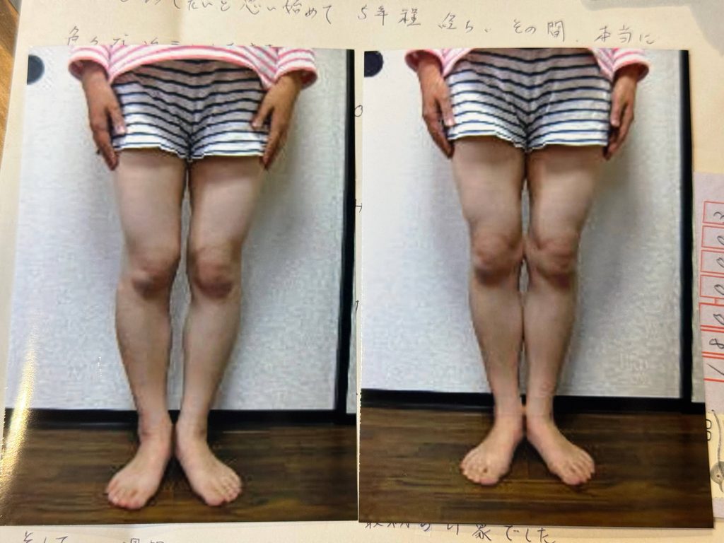 O脚ストレッチの体験談(※個人の感想)ビフォーアフター写真