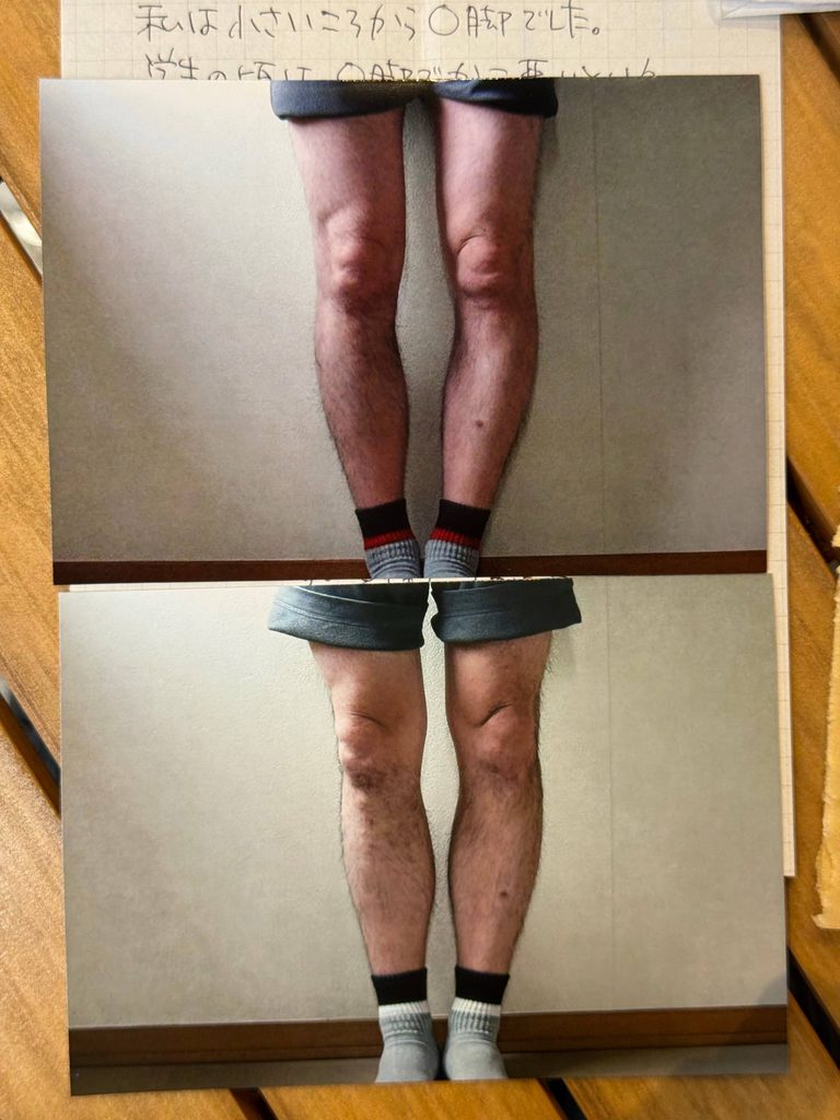 O脚ストレッチの体験談(※個人の感想)ビフォーアフター写真