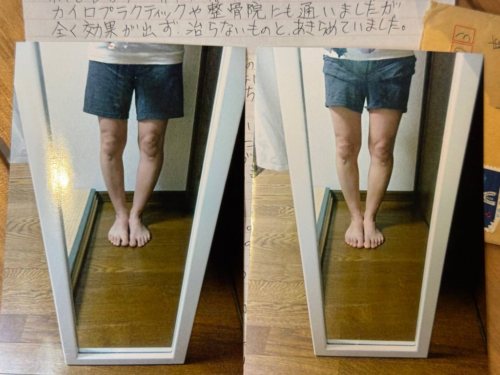 O脚ストレッチの体験談(※個人の感想)ビフォーアフター写真