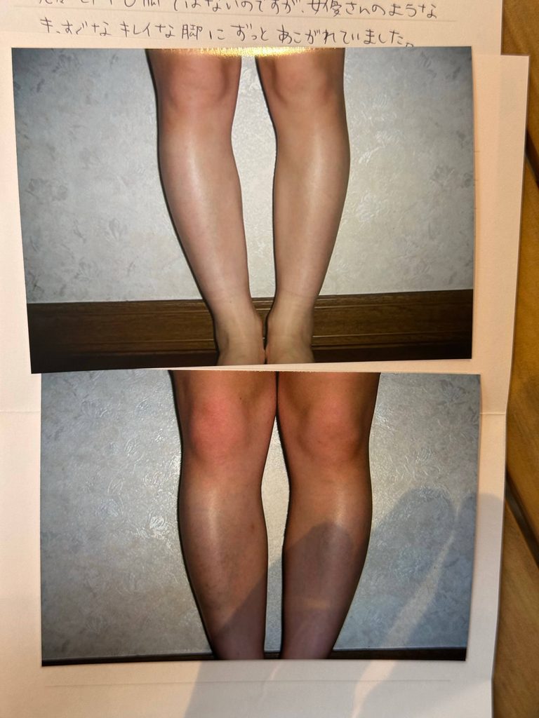 O脚ストレッチの体験談(※個人の感想)ビフォーアフター写真