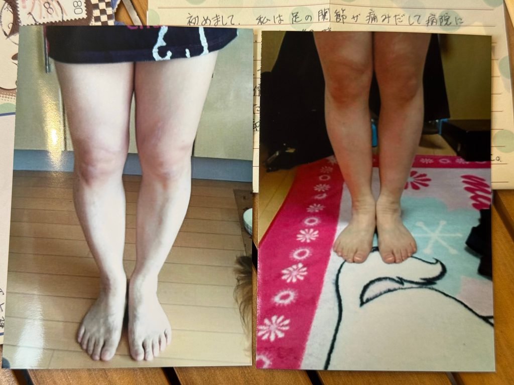 O脚ストレッチの体験談(※個人の感想)ビフォーアフター写真