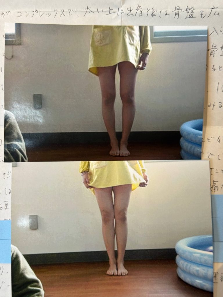 O脚ストレッチの体験談(※個人の感想)ビフォーアフター写真